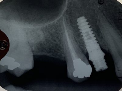 Minimally Invasive Dental Implant Placement